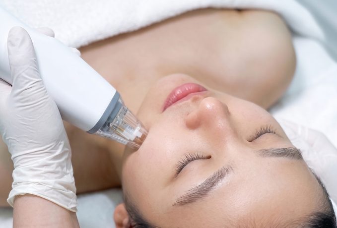 A woman receiving RF microneedling treatment at a clinic, with a hand holding a microneedling device near her cheek.