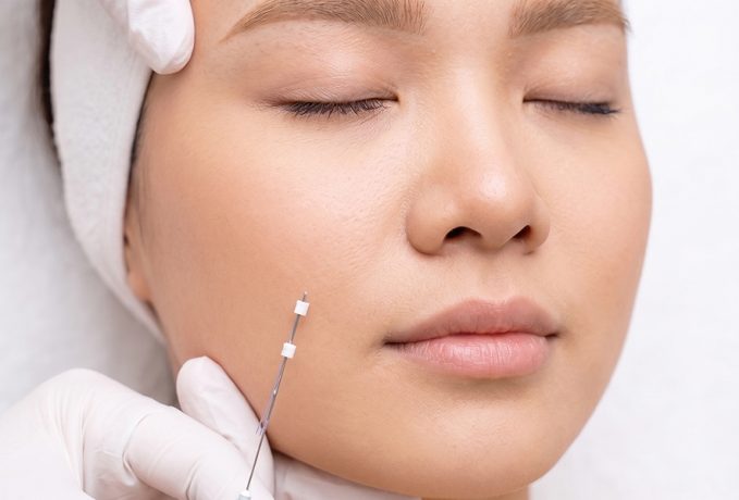A close-up of a woman receiving a PDO thread lift treatment, showcasing a needle near her cheek.