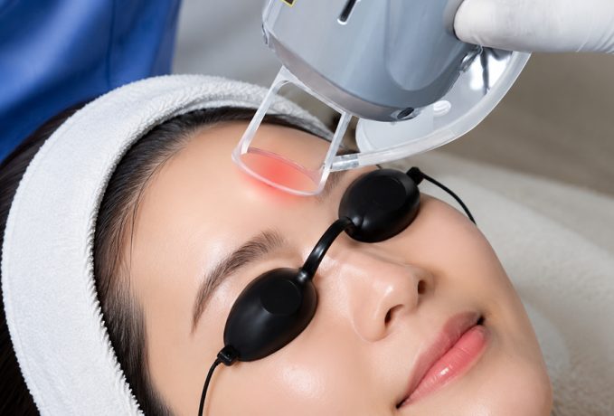 A close-up view of a skin treatment procedure using a handheld device on a client's head.