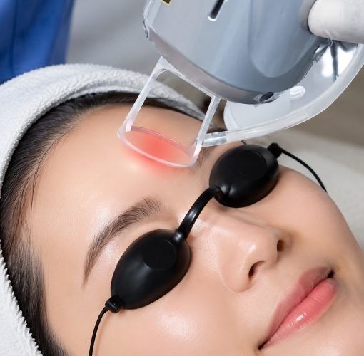 A woman receiving a 3D PICO Glow treatment with protective goggles on, while a laser device is pointed at her forehead.