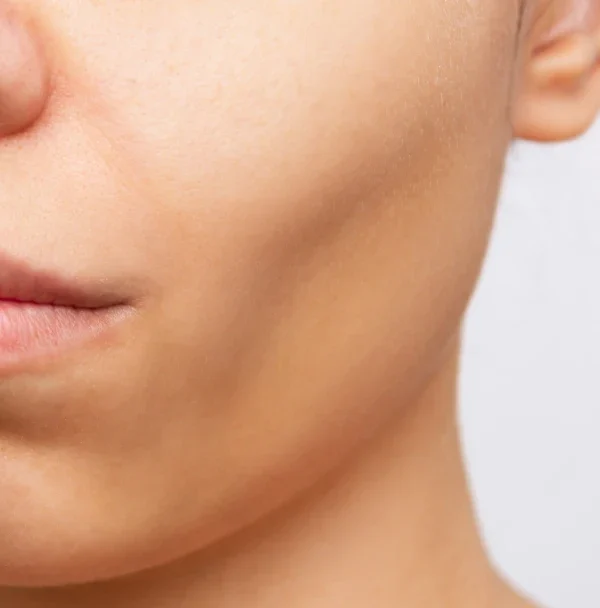 Glowwis Hollow Cheek Aesthetic Medical Clinic in Singapore