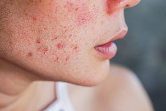 Acne - Glowwis | HIFU, Fillers, Collagen Skin Boosters & Lasers | Medical Aesthetic Clinic In Singapore