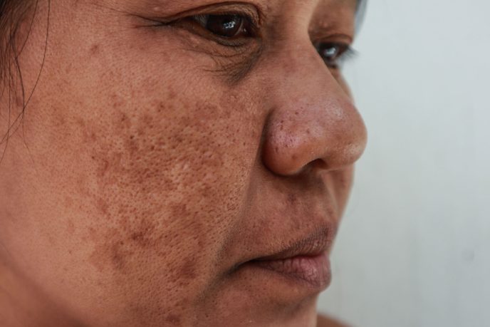 Glowwis Melasma -Aesthetic Medical Clinic in Singapore