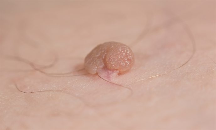 Wart Removal | Aesthetic Medical Clinic in Singapore