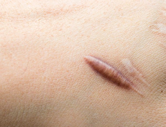 Skin Tag Removal | Aesthetic Medical Clinic in Singapore