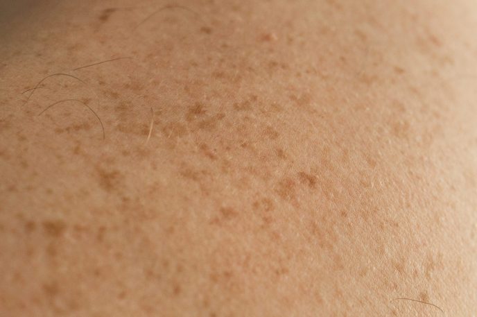 Glowwis | Pigmentation Removal | Medical Aesthetic Clinic In Singapore
